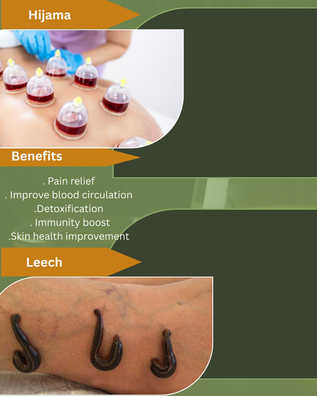 Hijama and Leech Therapy